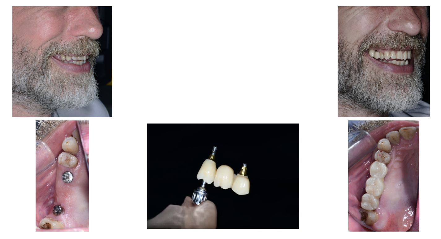 Antes y después de rehabilitación dental con implantes