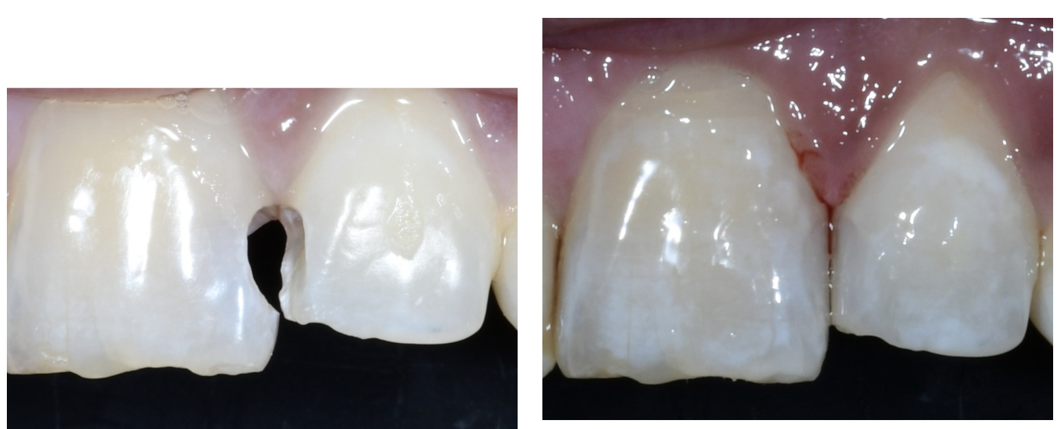 Antes y después de restauración estética con carillas dentales — caso real tratado en Independencia Unidad Dental