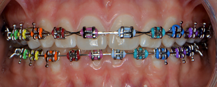 Proceso del tratamiento de ortodoncia con brackets