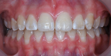 Después del tratamiento de ortodoncia con brackets