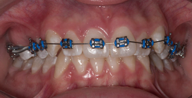 Antes del tratamiento de ortodoncia con brackets
