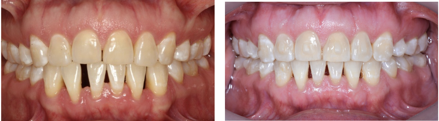 Antes y después de tratamiento de alineación dental